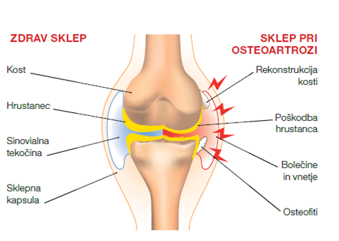 Slika prikazuje razliko med zdravim in prizadetim sklepom. ALI STE VEDELI? Za osteoartrozo trpi okrog 40 % ljudi, starih med 45 in 75 let. | Foto: 