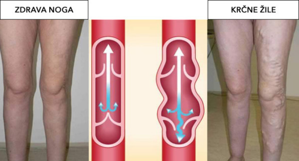 žile vene NET SALES | Foto: 