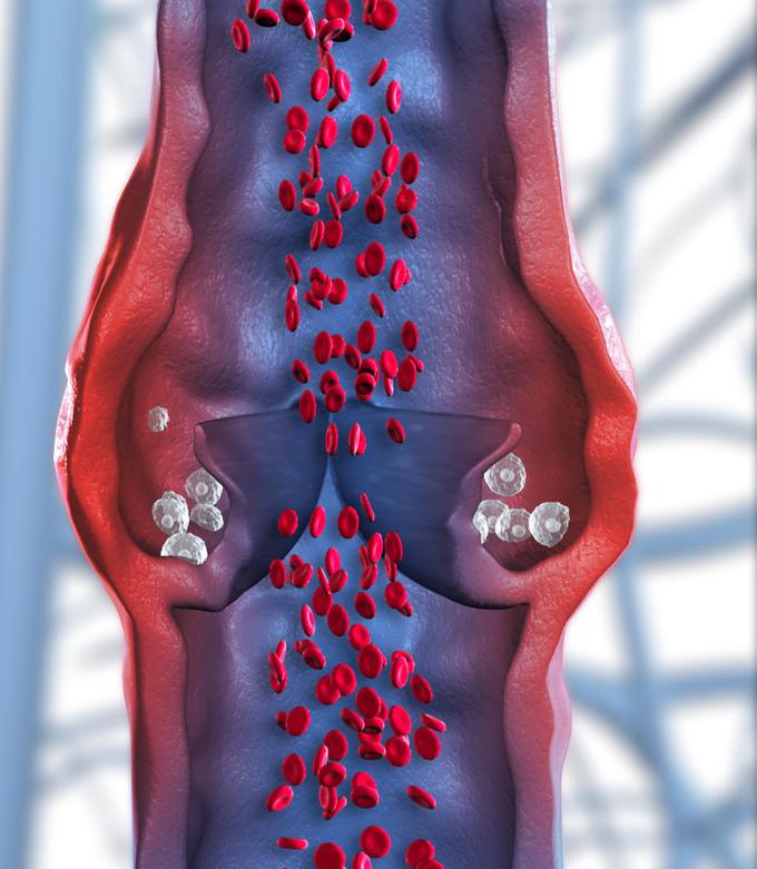 Ko zaklopke in venske stene slabijo, se vene razširijo, in zaradi slabšega pretoka krvi nazaj proti srcu venska kri zastaja. | Foto: 
