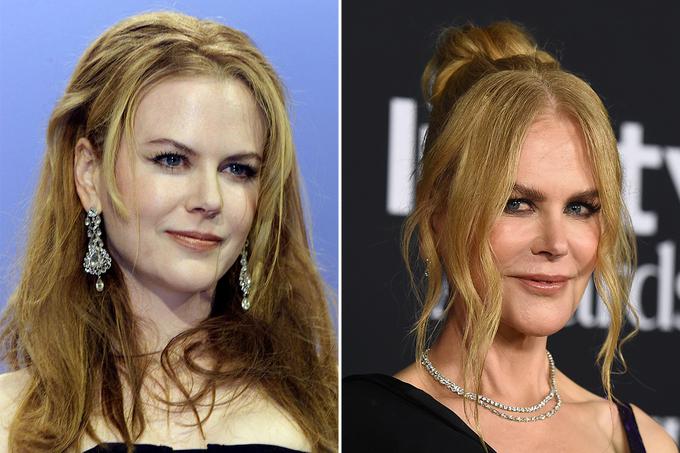 Nicole Kidman B&A | Foto: Reuters