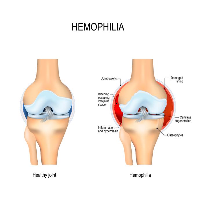 Ena od pogostih posledic hemofilije je tudi spontano obsežno krvavenje v sklepe. | Foto: Getty Images