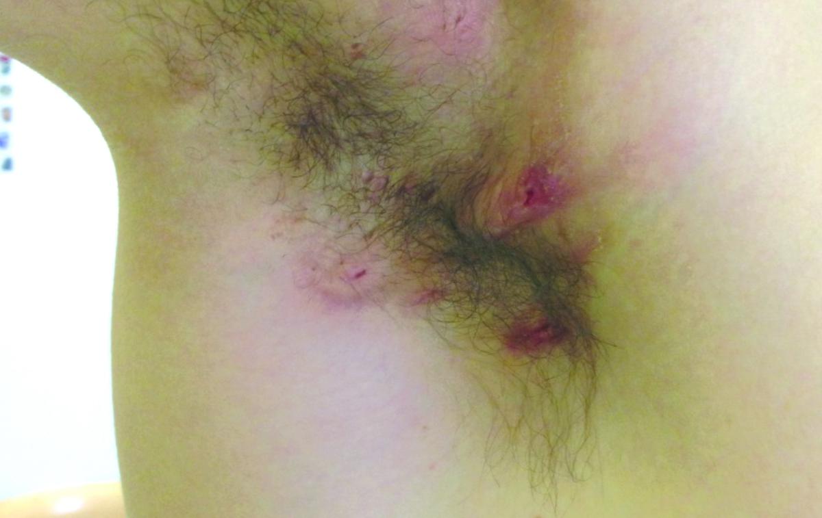 HS kožna bolezen Hidradenitis suppurativa | Začne se z mozoljčki, ki rastejo, pozneje se lahko pojavijo turi, ki so med seboj povezani s kanali, in hude brazgotine. | Foto Hidradenitis suppurativa Slovenija