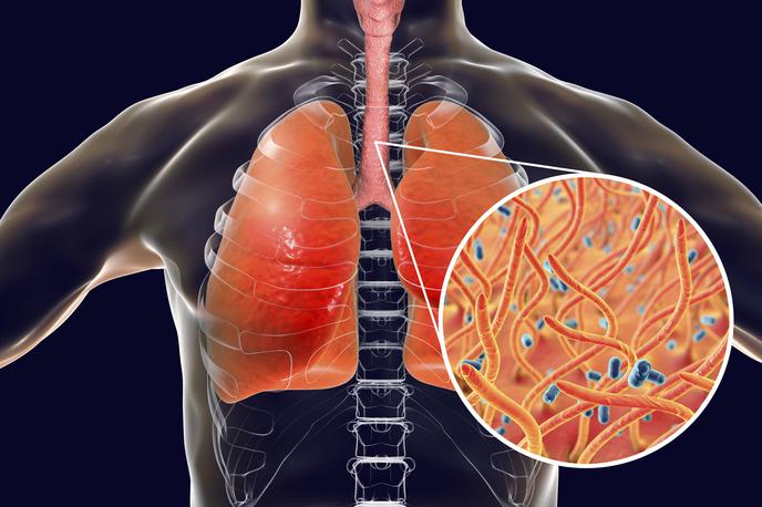 oslovski kašelj | Oslovski kašelj je bolezen dihal, ki jo povzroča bakterija Bordetella pertussis, ki se nahaja v ustih, nosu in žrelu. Otroci, ki zbolijo za oslovskim kašljem, imajo lahko epizode kašlja, ki trajajo od štiri do osem tednov. | Foto Guliverimage