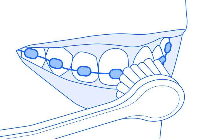 Ščetka Curaprox Hydrosonic pro je primerna tudi za tiste, ki nosijo fiksni ortodontski aparat. | Foto: Curaden Slovenija d.o.o.
