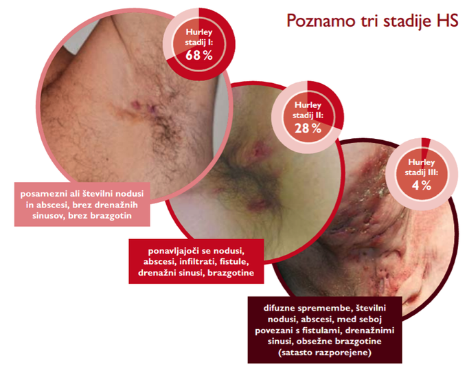 HS kožna bolezen Hidradenitis suppurativa | Foto: Hidradenitis suppurativa Slovenija