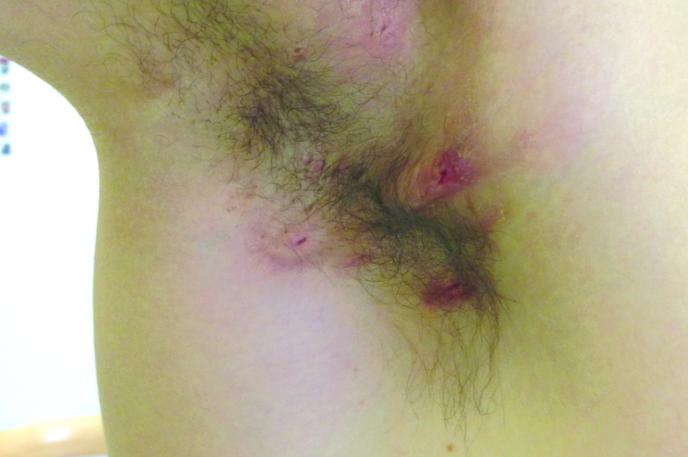 HS kožna bolezen Hidradenitis suppurativa | Začne se z mozoljčki, ki rastejo, pozneje se lahko pojavijo turi, ki so med seboj povezani s kanali, in hude brazgotine. | Foto Hidradenitis suppurativa Slovenija