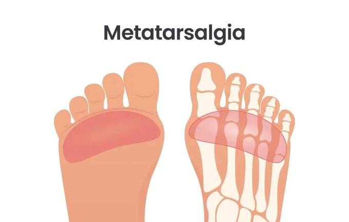 Metatarzalgija-bolecine-v-stopalu | Foto: Medicofit