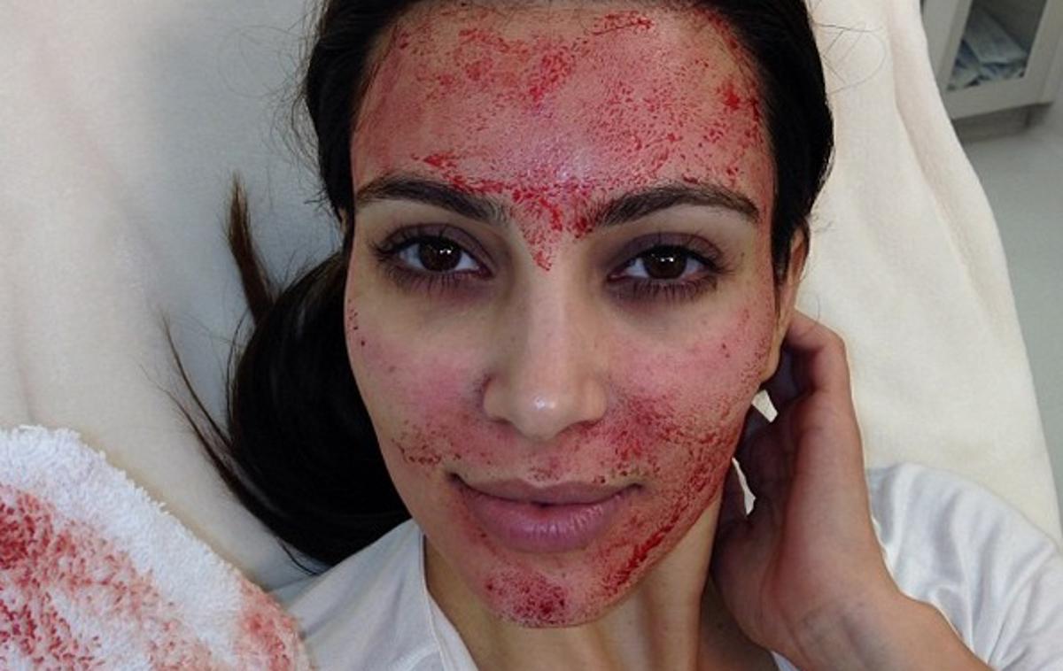 Kim Kardashian vampirski lifting | Foto Instagram