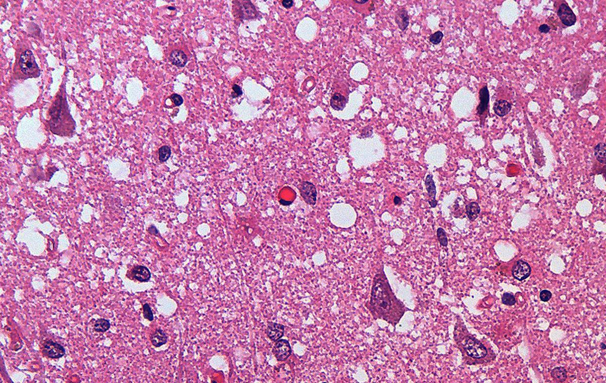 Prionska bolezen, prioni | Ker je neozdravljiva in napreduje zelo hitro, je trenutno daleč najboljša zaščita pred katerokoli prionsko boleznijo dejstvo, da je njihova pojavnost razmeroma redka. Na fotografiji mikroskopska povečana možganskega tkiva osebe, ki je umrla zaradi Creutzfeldt-Jakobove bolezni. | Foto Wikimedia Commons / Tulemo