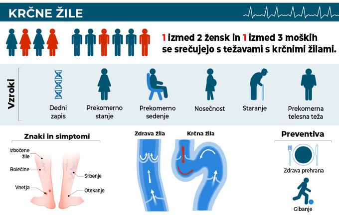 Krčne žile so zelo pogost pojav. Zadnje statistike kažejo, da se z njimi v življenju sreča kar polovica vseh ljudi. | Foto: 