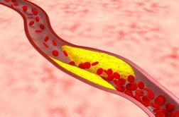 Holesterol je nujen za življenje, a je tudi vodilni vzrok smrti