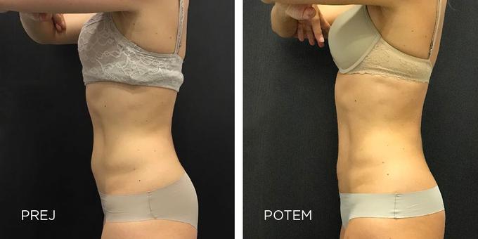 CoolSculpting poseg | Foto: 