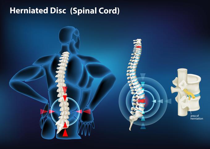 diskus-hernija-medicofit | Foto: Medicofit